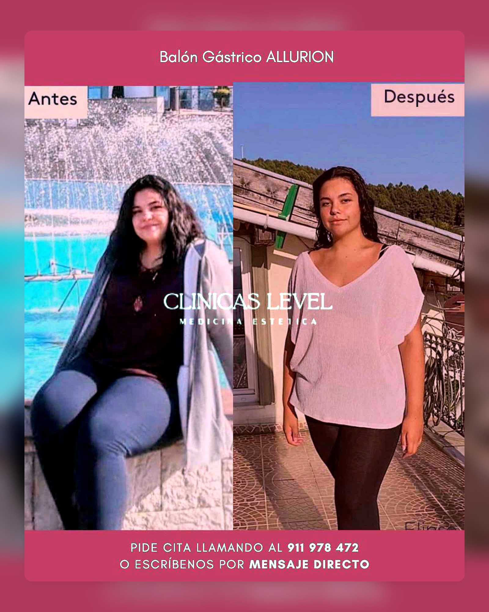 Resultados reales de balón gástrico en Clínicas Level